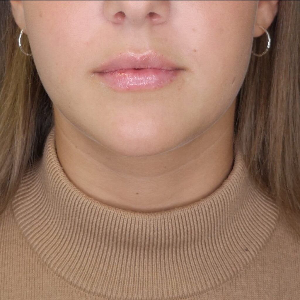 Närbild av en kvinnas nedre ansikte som visar hennes näsa, mun och haka, iklädd ringörhängen och en polotröja.