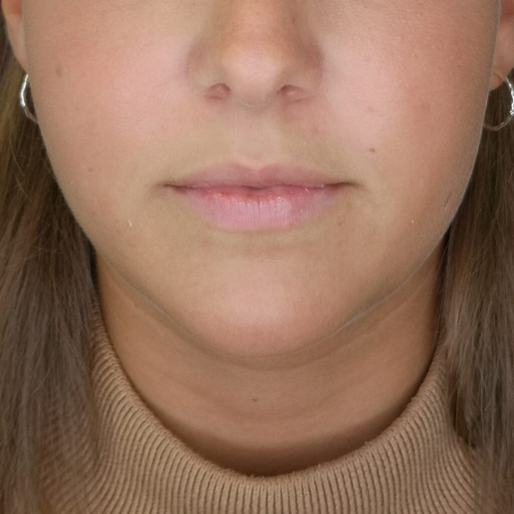 Närbild av en kvinnas nedre ansikte, visar hennes näsa, mun och haka, med ett neutralt uttryck.