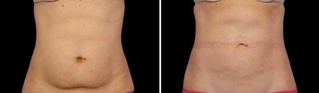 Före och efter bukkirurgi, med den vänstra bilden som visar det preoperativa tillståndet och den högra bilden visar det postoperativa tillståndet med kirurgiskt snitt och läkande ärr.