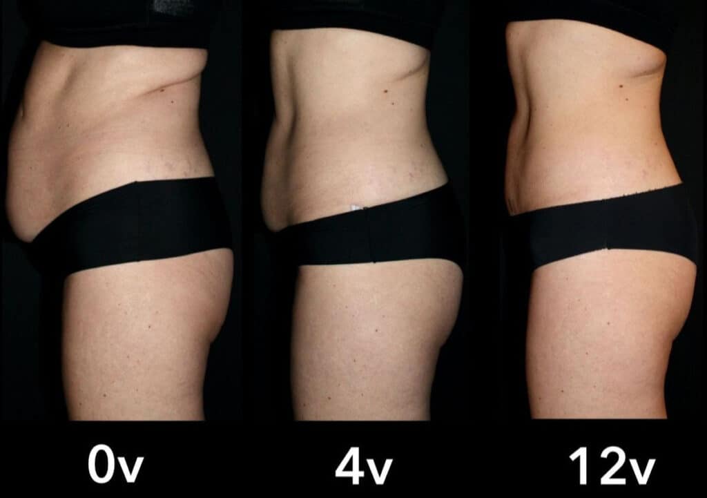 En utveckling av tre sidobilder som visar en persons buk vid 0 veckor, 4 veckor och 12 veckor, som illustrerar förändringar i kroppskonturen.