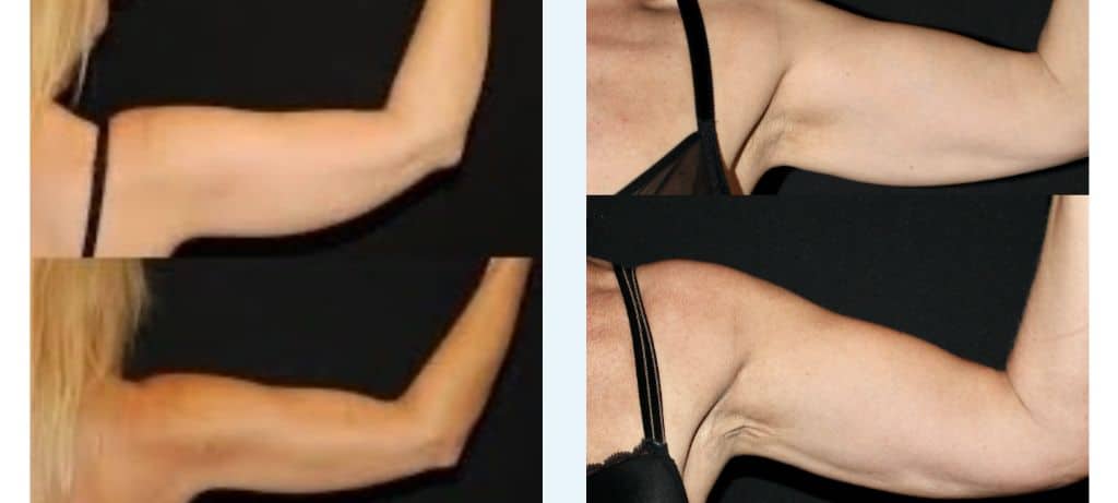 Kvinnas armar före och efter coolsculpting behandling