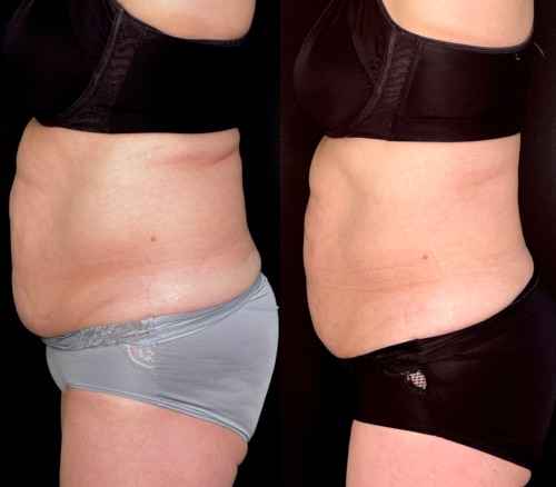 Kvinnas mage före och efter en behandling med Coolsculpting